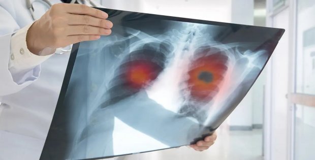 Elektronik sigara akciğerleri vuruyor