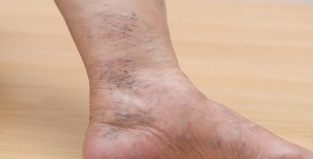 Uzmanından uyarı: 'İleri derecedeki varis hayatı tehdit edebilir'